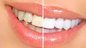 Teeth Whitening 2